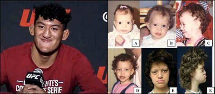 What Is Pallister W Syndrome and Is It the Reason Behind Raul Rosas Jr